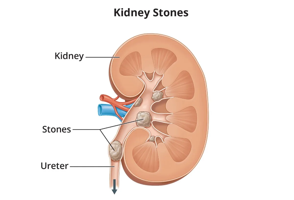Kidney stone